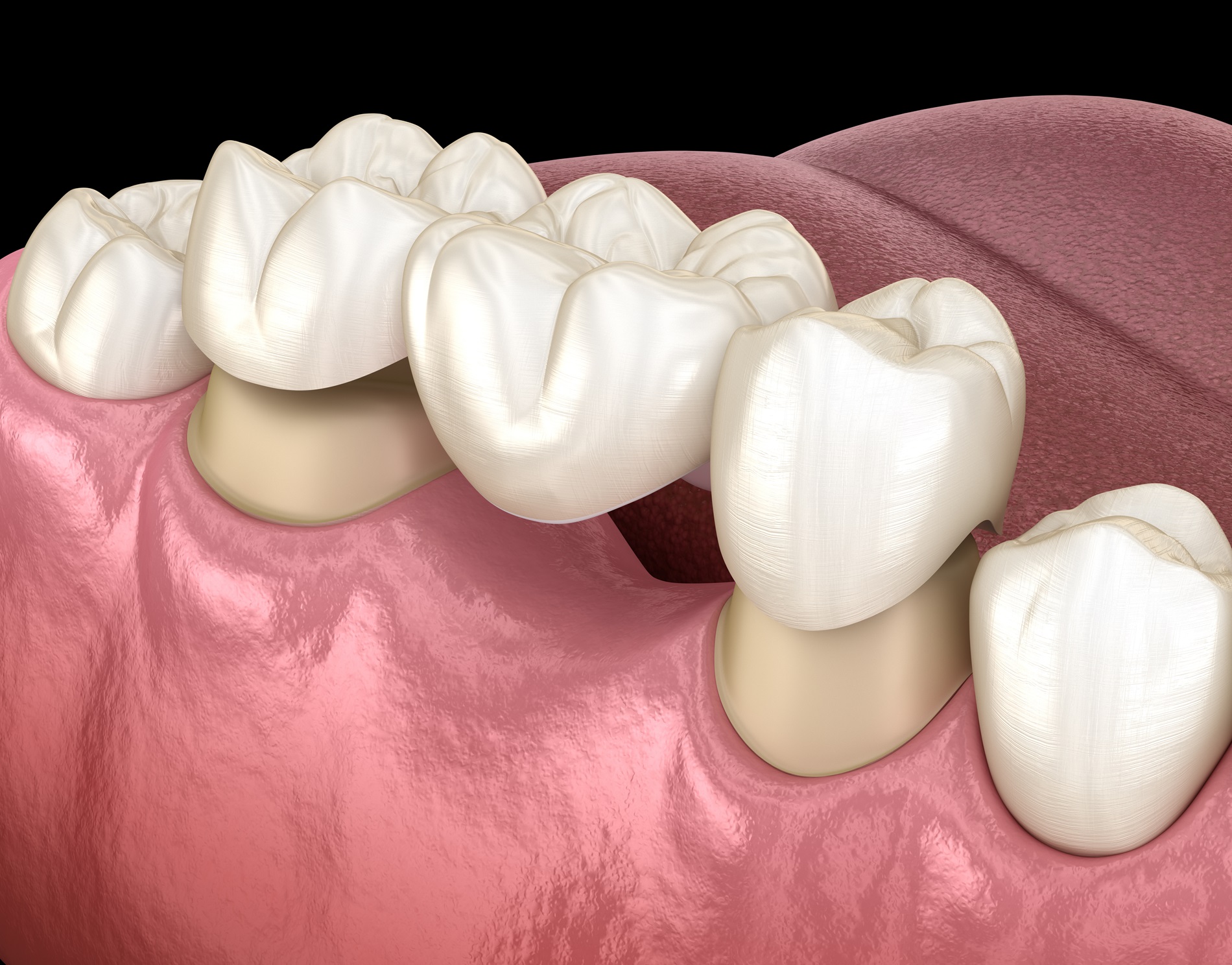 Dentist in Barnes offering replacement of missing teeth
