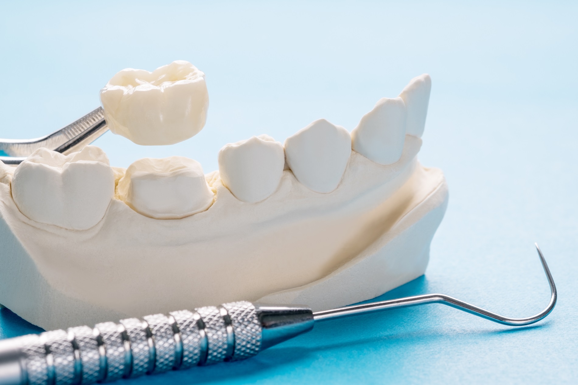 Emergency dentist in Putney offering refitting dental caps or crowns