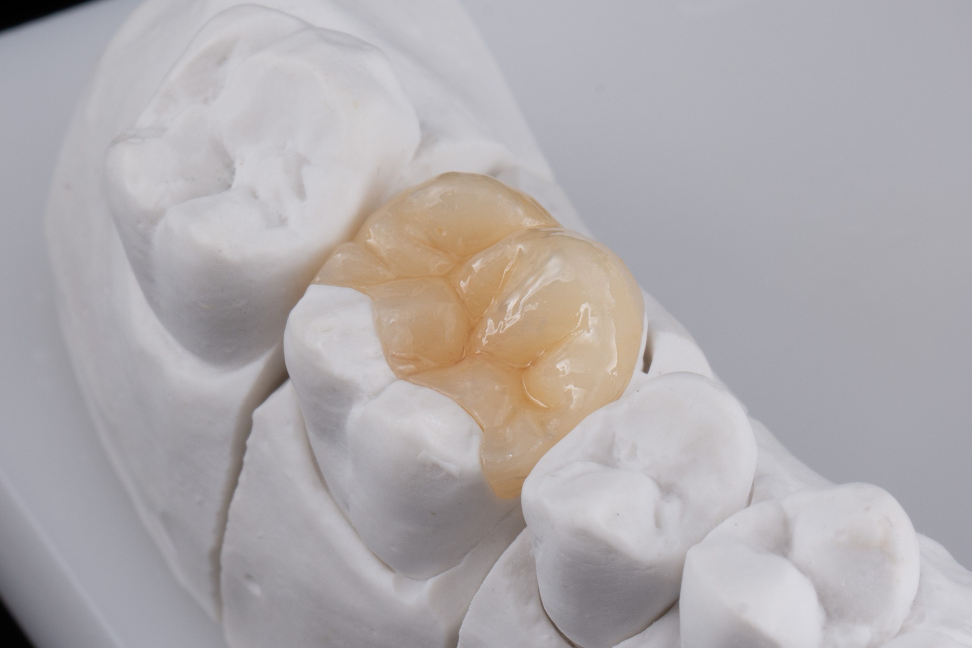 Minimally invasive dental treatment in Putney