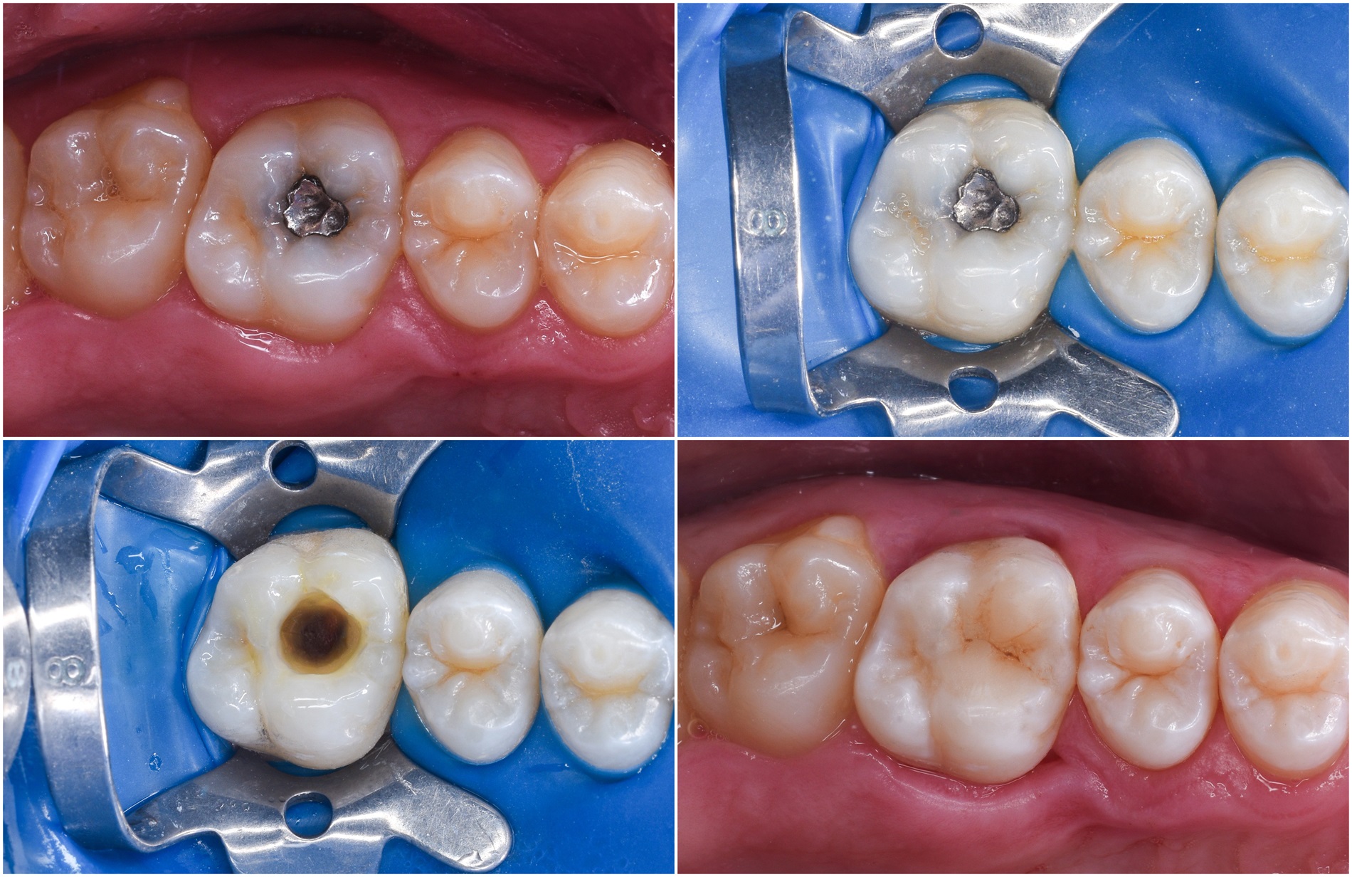 Dentist in Putney offering minimally invasive white filling