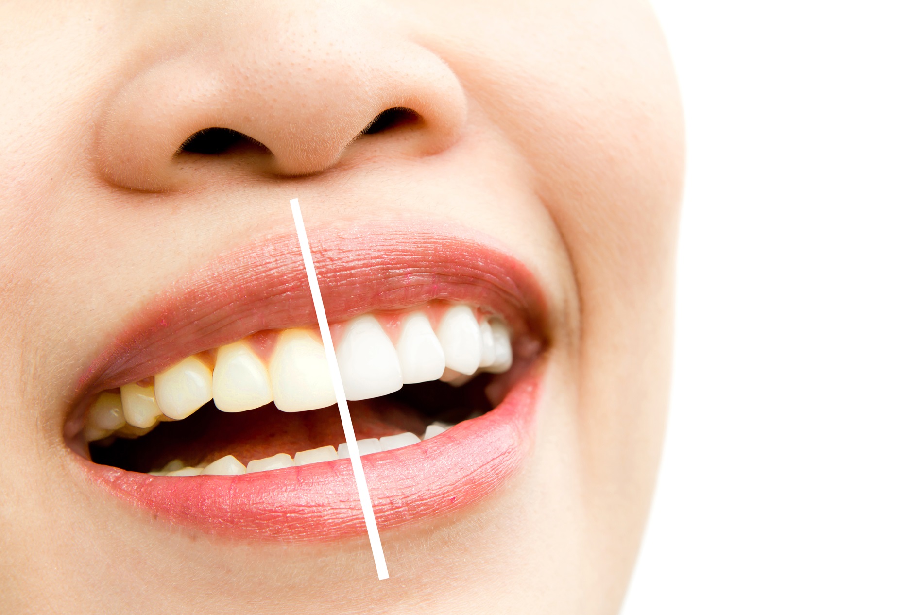 Dentist in Putney offering discount on teeth whitening